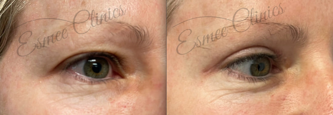 Before and After img